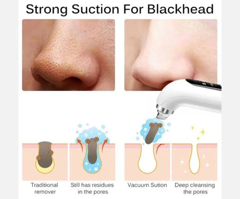 Facial 5 in 1 Blackhead Remover Machine
